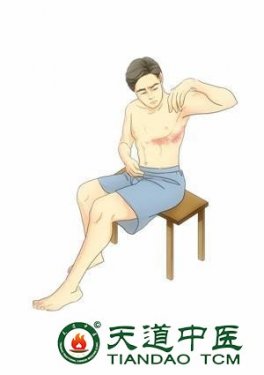 TCM treatment for postherpetic neuralgia(PHN）