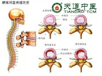 腰椎间盘突出压迫坐骨神经痛如何治疗?