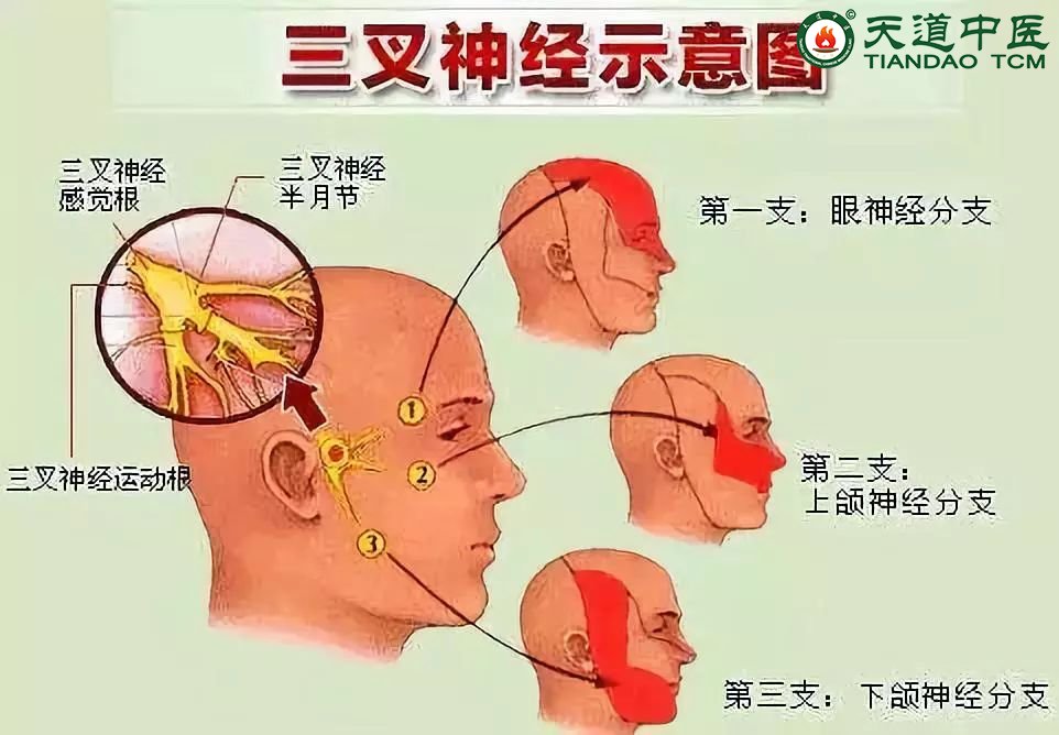 三叉神经痛