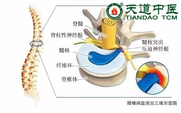 腰椎间盘突出