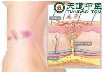 带状疱疹发作时注意事项 如何治疗