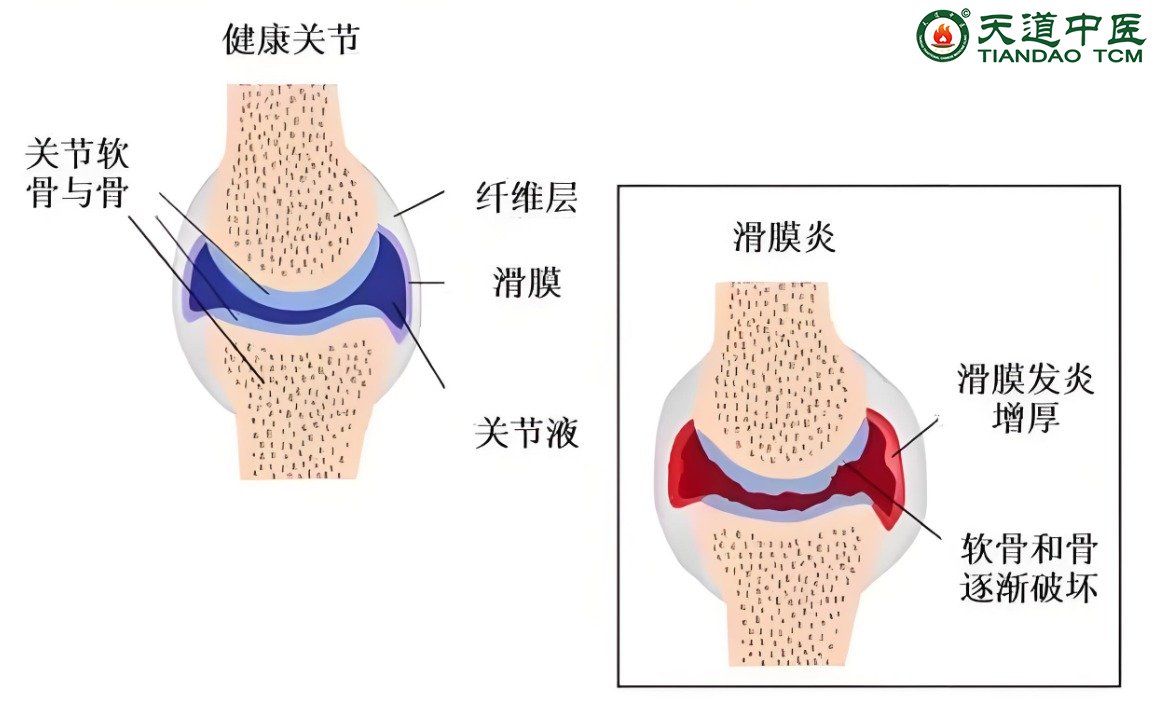 滑膜炎